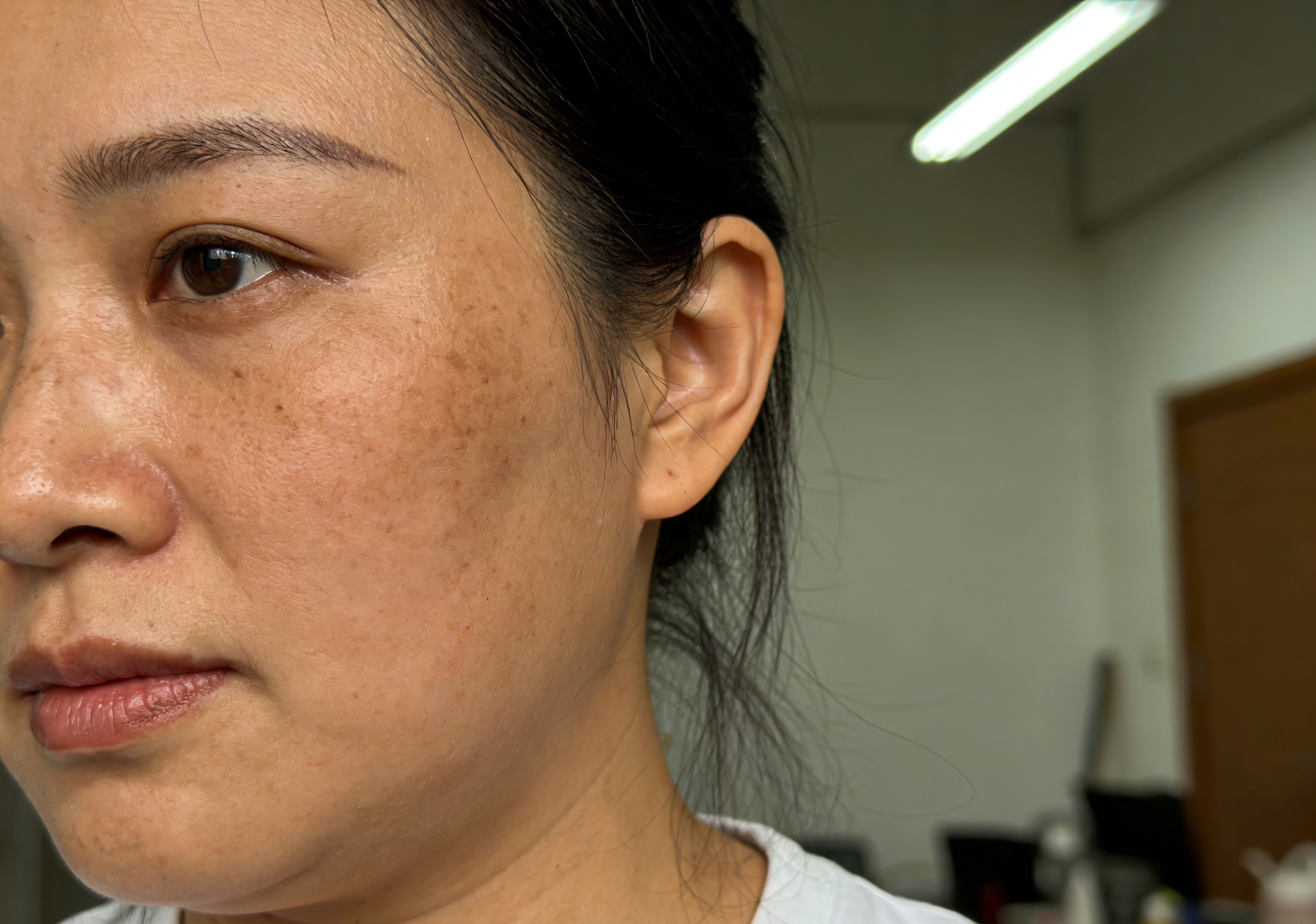 Victoria Beauty GLOW² 療程前後對比 - 毛孔精細、黑頭清除及即時水潤透亮效果Victoria Beauty before and after GLOW² treatment - refined pores, removed blackheads and instant hydrated glow